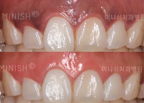 Gum Bleaching