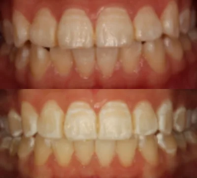 White spots after whitening