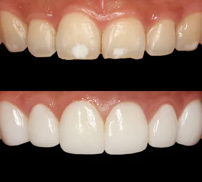 Veneers solution