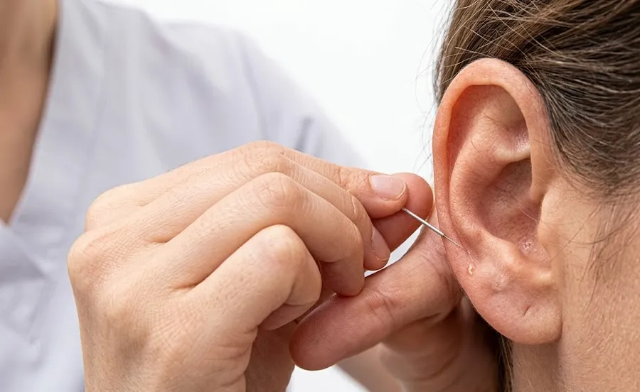 Acupuncture Therapy