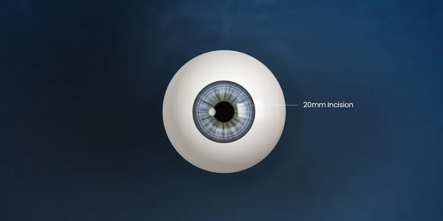 LASIK in Korea